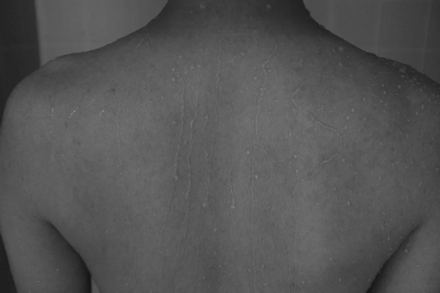 Swelling